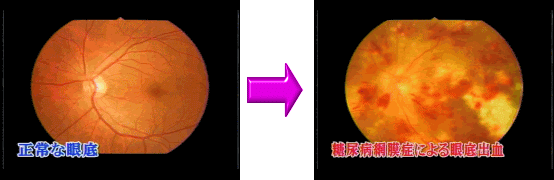 糖尿病性網膜症