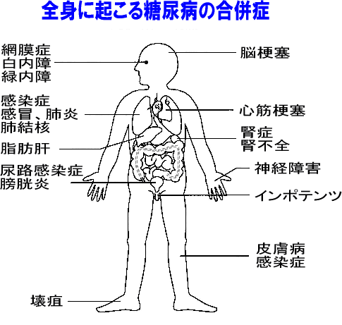 全身に起こる糖尿病の合併症