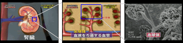 糖尿病の三大合併症