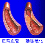 正常血管と動脈硬化